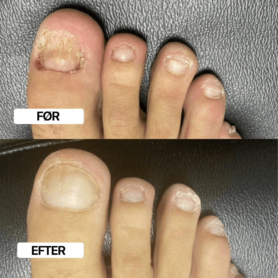 ClearToe™ svampespray | 99 % af neglesvampen væk på 7 dage!